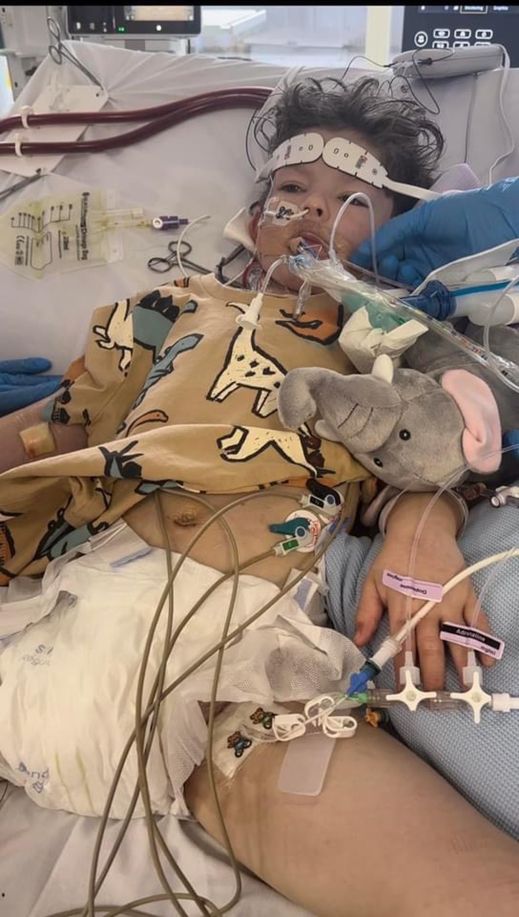 Rafi was put on an ECMO machine and dialysis