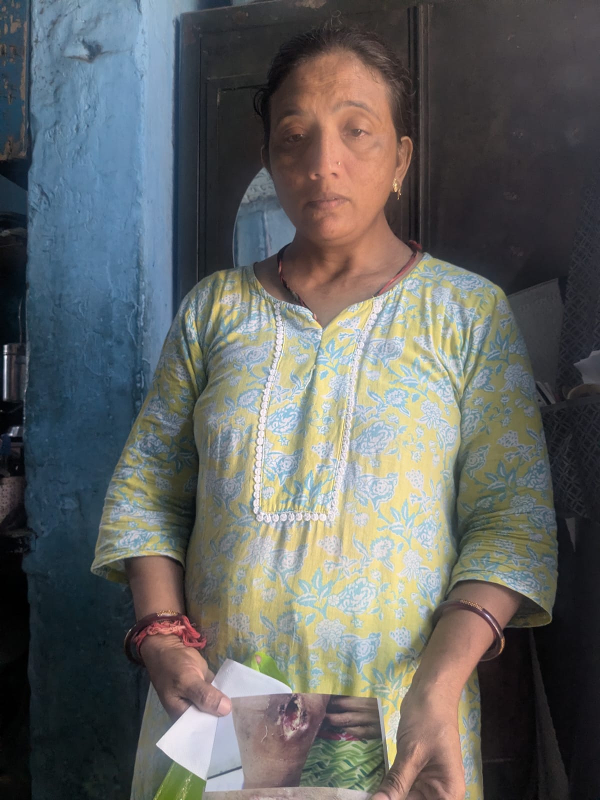 Toralben Lakshari, 43, showing pictures of her injury from the Air India crash