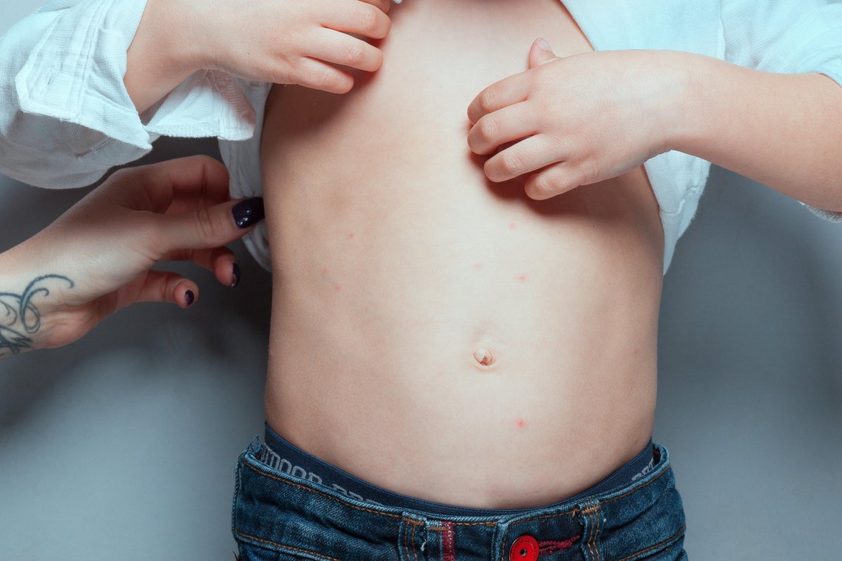 Measles symptoms as two children die following acu