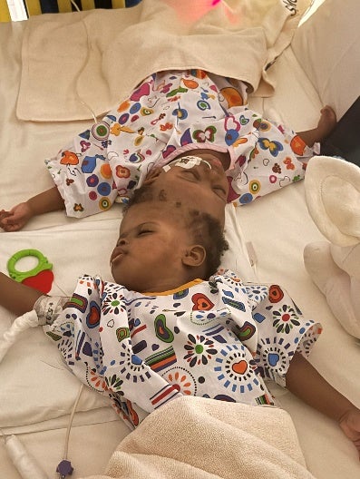 A UK charity, Gemini Untwined, has partnered with Abu Dhabi’s PureHealth to perform the nation’s first successful surgical separation of craniopagus twin girls, Nigerian born Mercy and Goodness, aged 19 months.