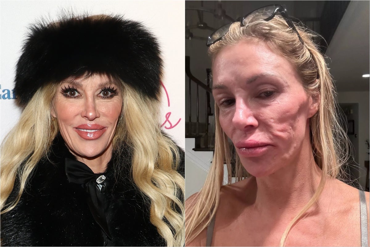 Ein Star der Reality-TV-Serie „Real Housewives“ gibt an, sich das Gesicht ...