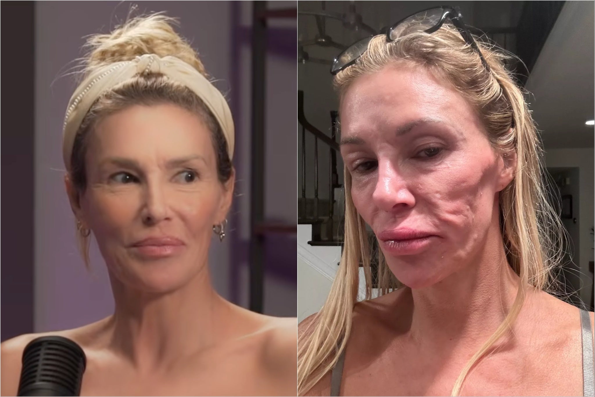 Real Housewives star plagued by skin parasite now says she has benign tumor in her face