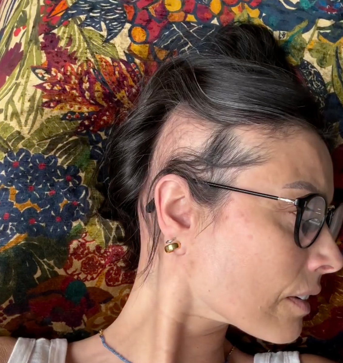 The star has alopecia and an autoimmune condition