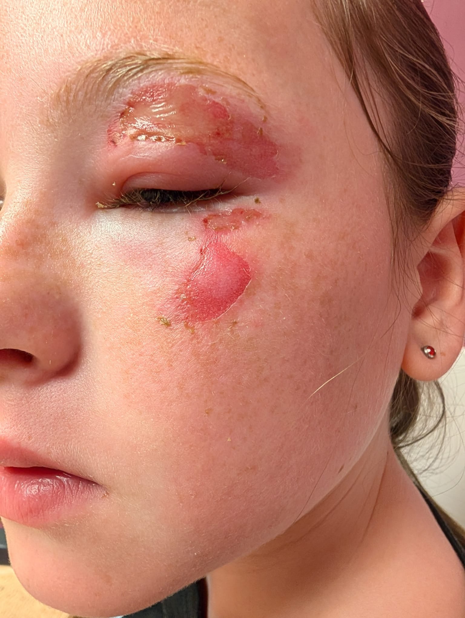 11-year-old Scarlet Rowe from Irvine, who was treated for burns to her face and eyelid after heating a squishy toy in May. Specialist burns staff at the Royal Hospital for Children
