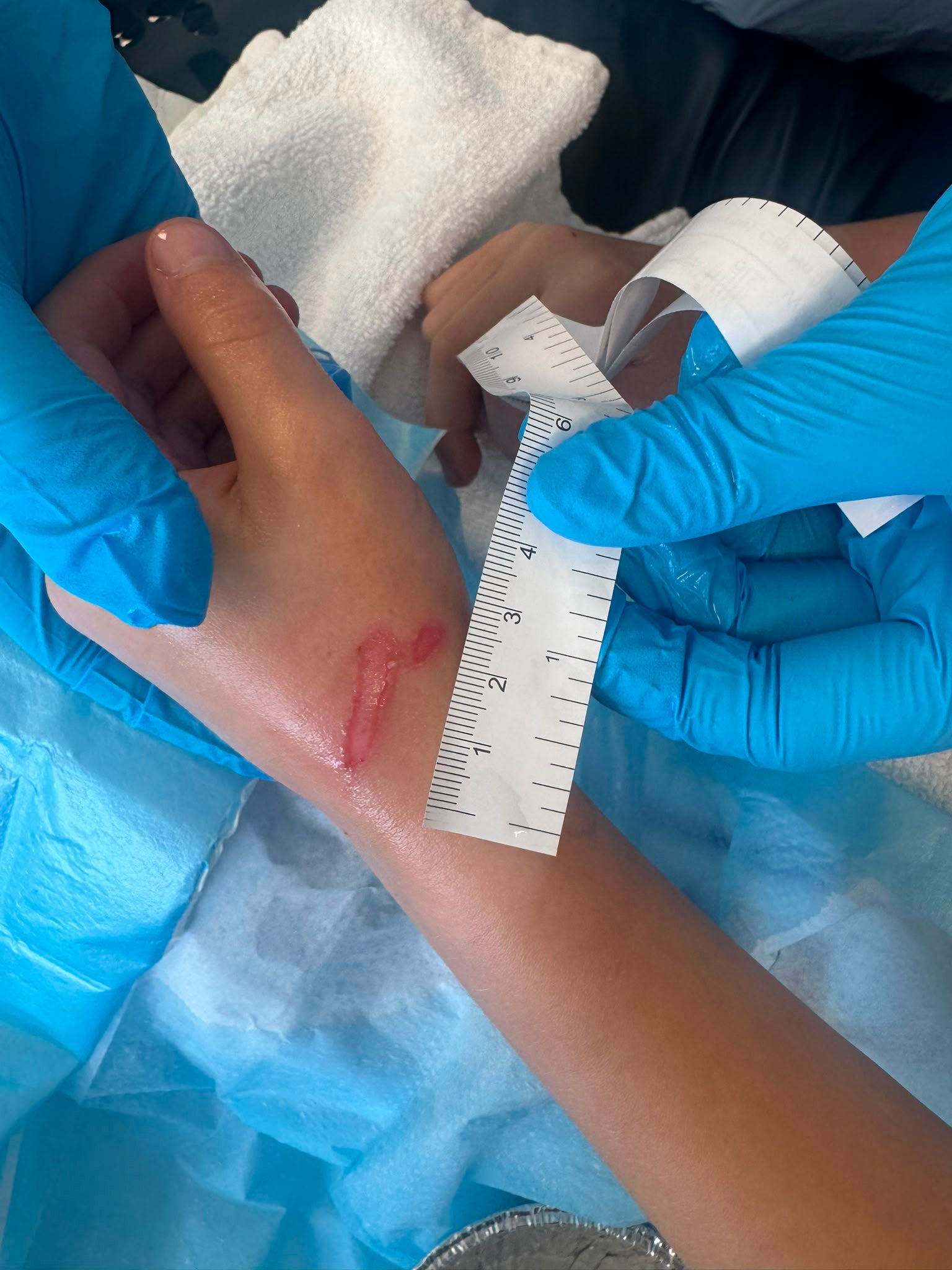 Eight-year-old Joseph from Clackmannanshire, who needed weeks of treatment and a skin graft after a heated squishy toy burst across his chest and hand