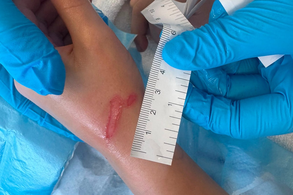 Eight-year-old Joseph after suffering burns linked to a heated squishy toy