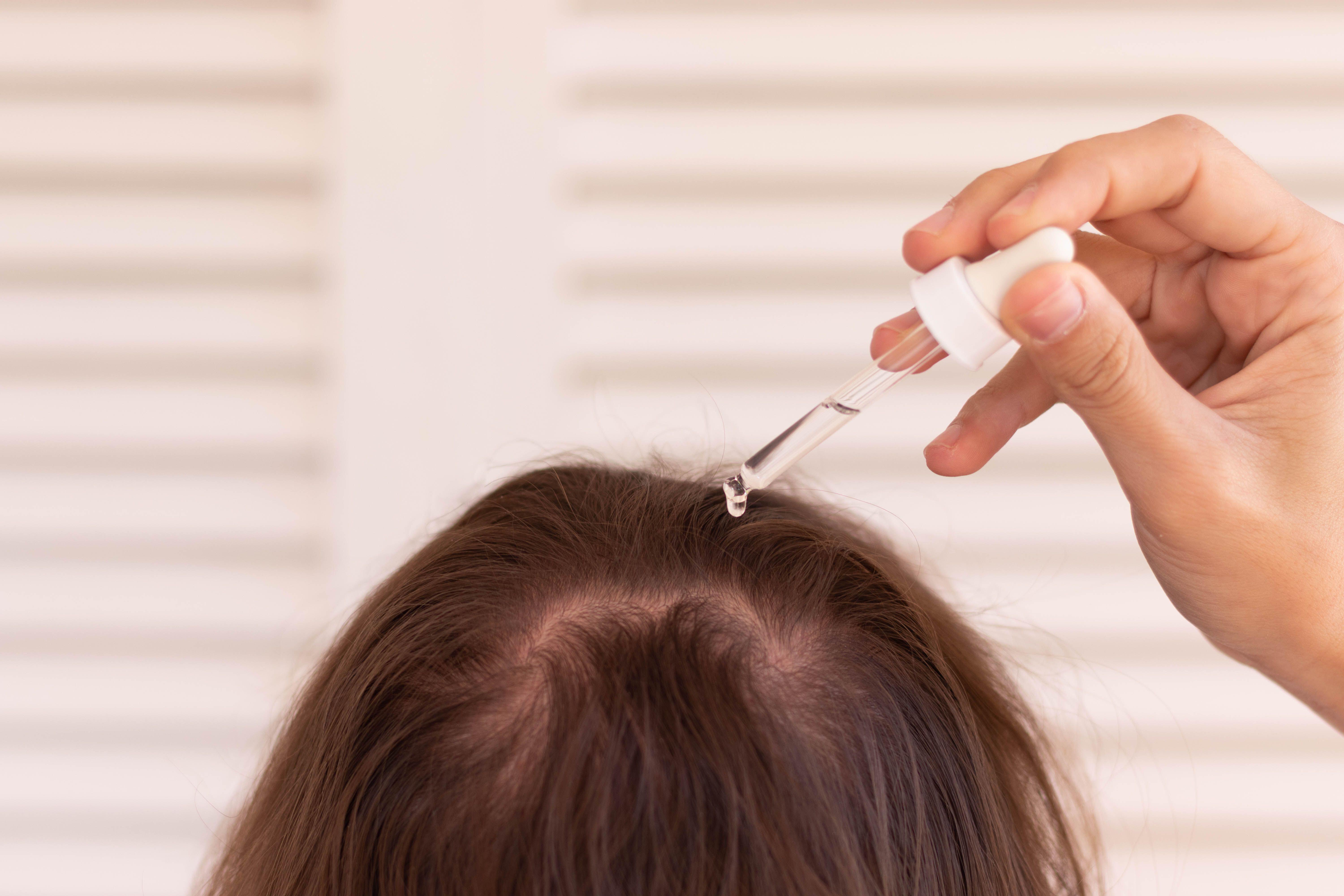 Topical minoxidil can be effective for hair loss (Alamy/PA)
