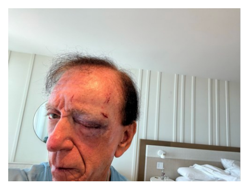 Arthur Elk, seen here following his run-in with a glass bathroom door at the W South Beach, says his life has been permanently altered, both physically and emotionally, by the 2023 incident (U.S. District Court for the Southern District of Florida)