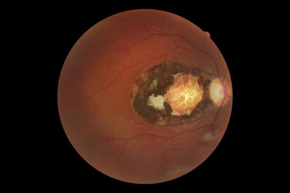 Cat parasite infection toxoplasmosis infecting third of humans is ‘major cause of vision loss’ – UK Times Cat parasite infection toxoplasmosis infecting third of humans is ‘major cause of vision loss’ – UK Times