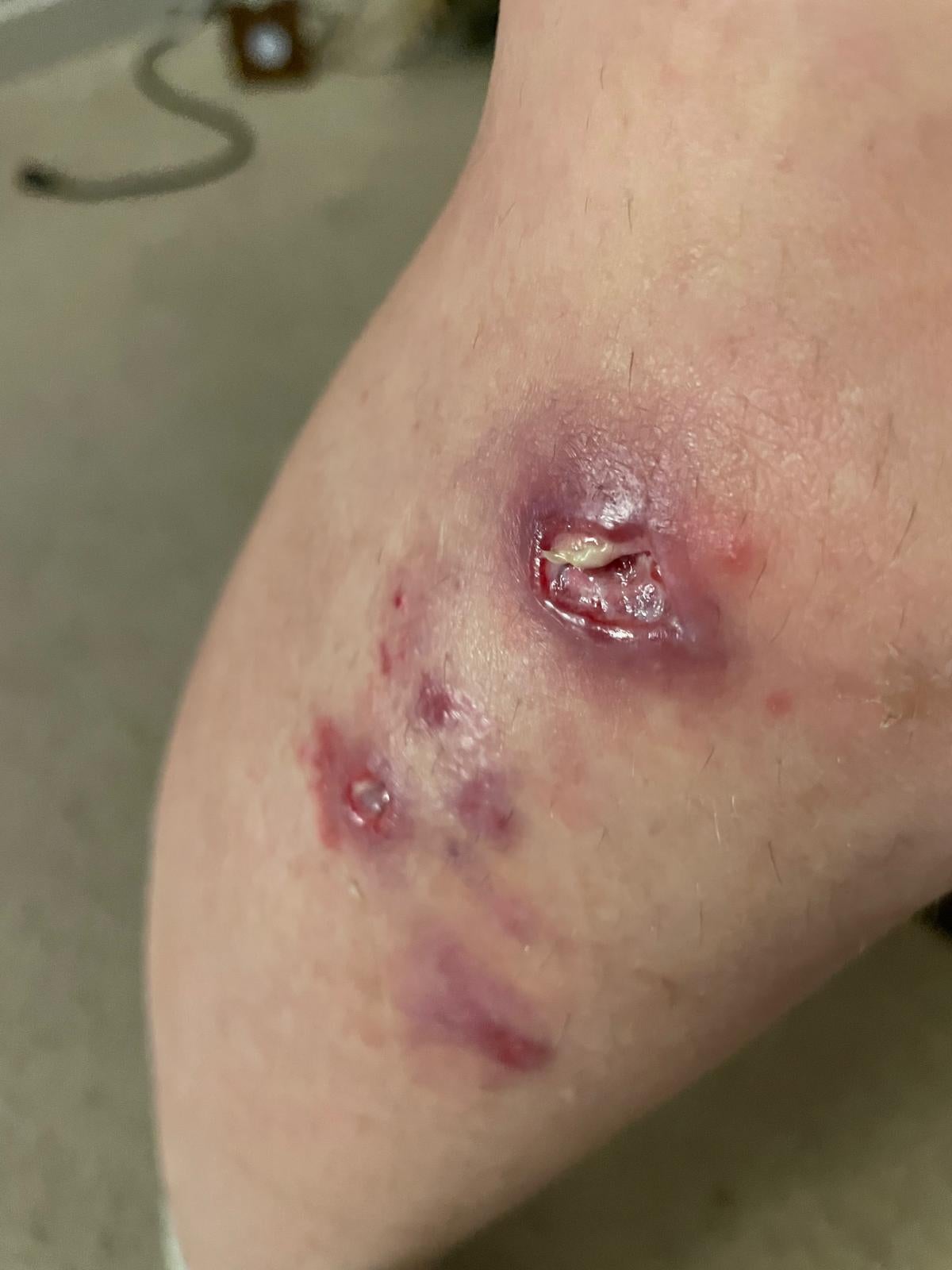 Katy Davies, who has been working as a postwoman in Bristol for around three years, suffered serious injuries in January 2026 when a dog attacked her while she was out delivering mail. (PA)