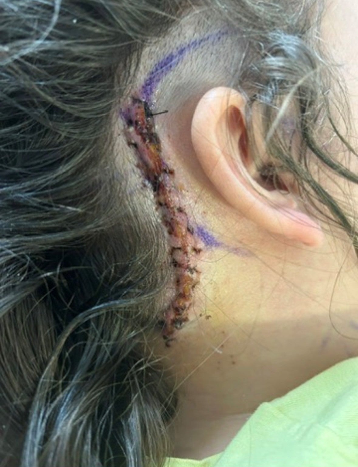 The tumour could not be removed because of its location around critical blood vessels