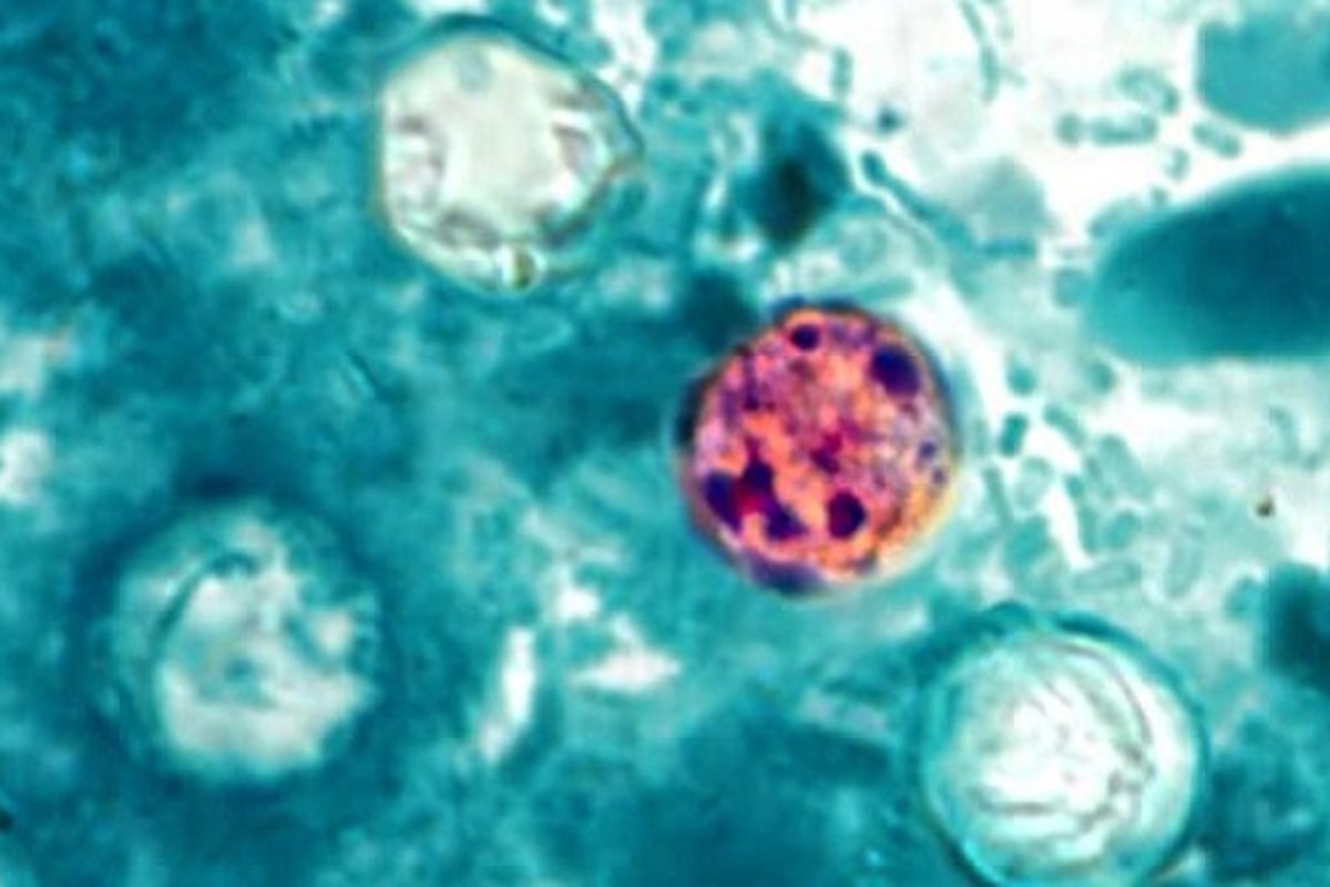 Parasite that causes ‘explosive diarrhea’ has infected over 1,000 in 17 states – here is how to stay safe – UK Times Parasite that causes ‘explosive diarrhea’ has infected over 1,000 in 17 states – here is how to stay safe – UK Times