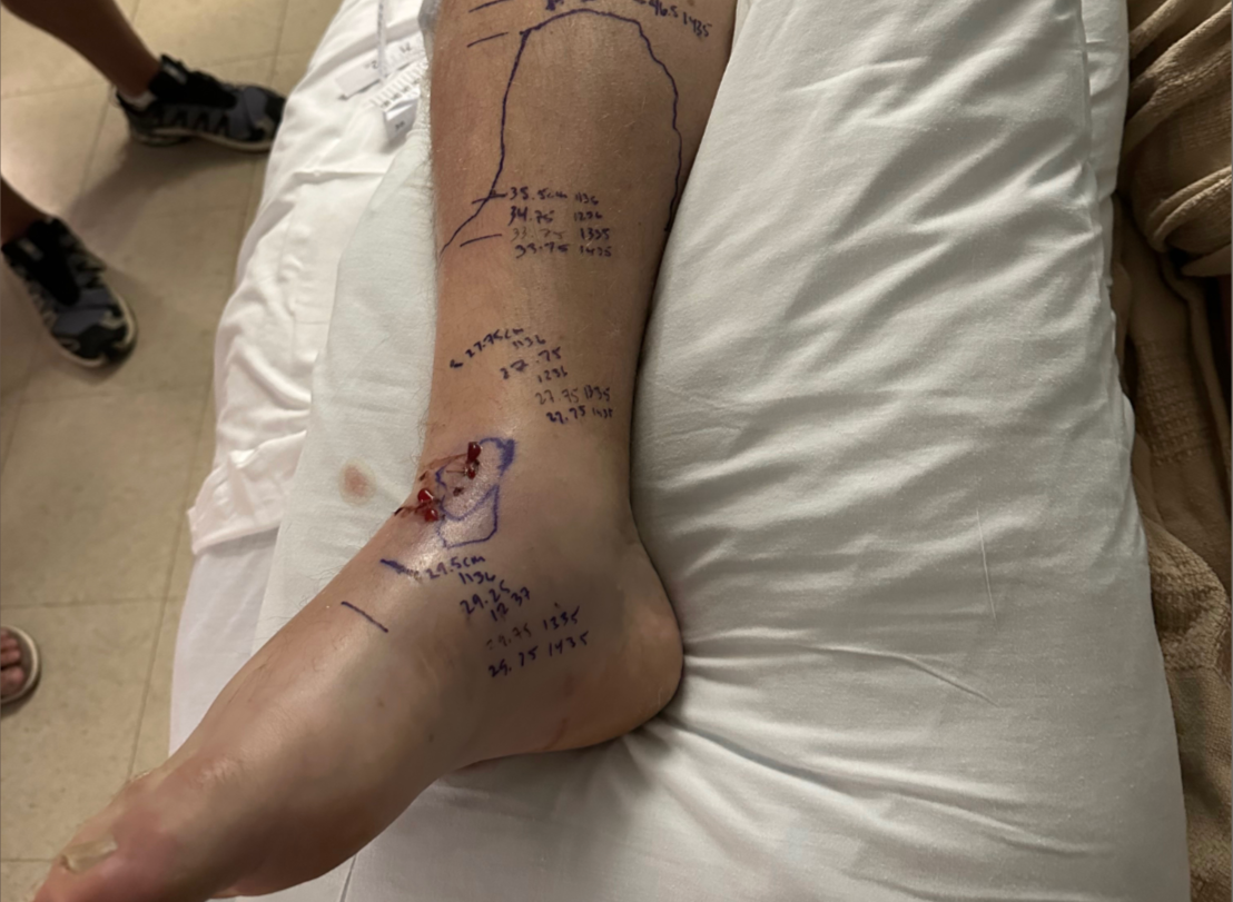 Chris was bitten twice with one bite going through a vein. His wife said that the venom went straight into his bloodstream