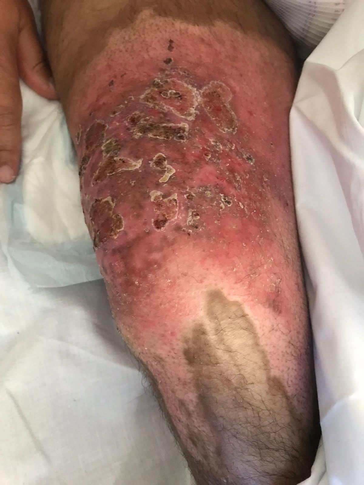 A burn sustained by Grant McPherson