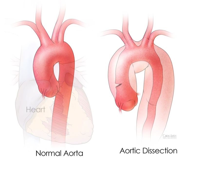 Graham died suddenly from an aortic dissection, according to initial medical reports. Here a chart shows the condition.