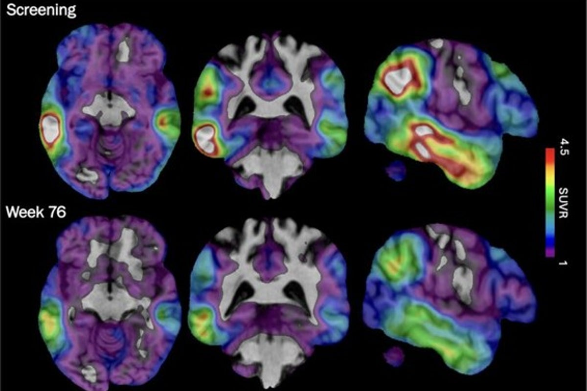New experimental drug shows promise in slowing early Alzheimer&rsquo;s