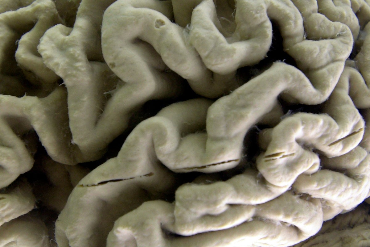 Study shows a blood test can help identify healthy people at high risk for Alzheimers disease