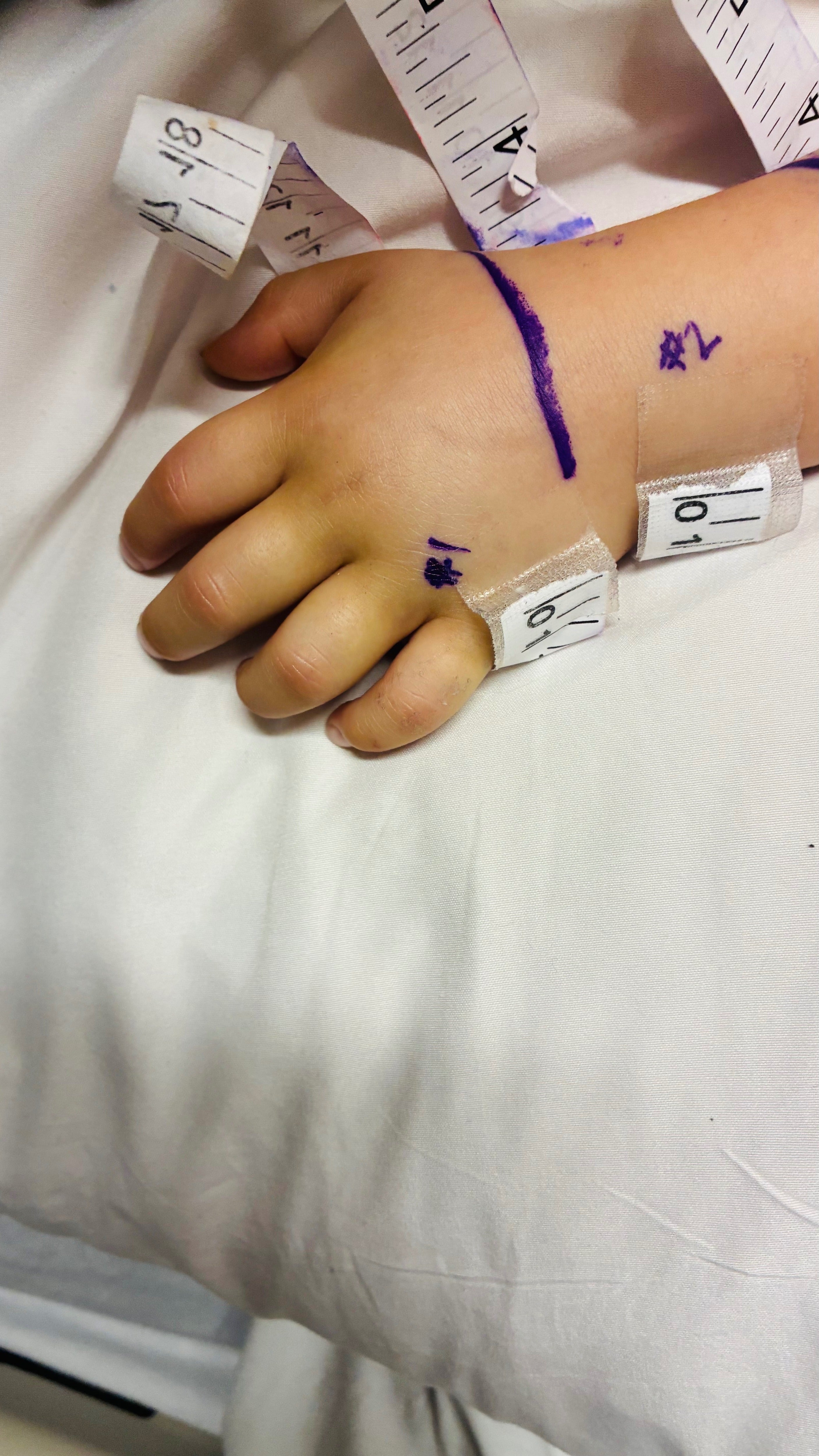 Three-year-old Addy of Santa Clarita, California, had to spend two nights in the ICU and receive three doses of antivenom