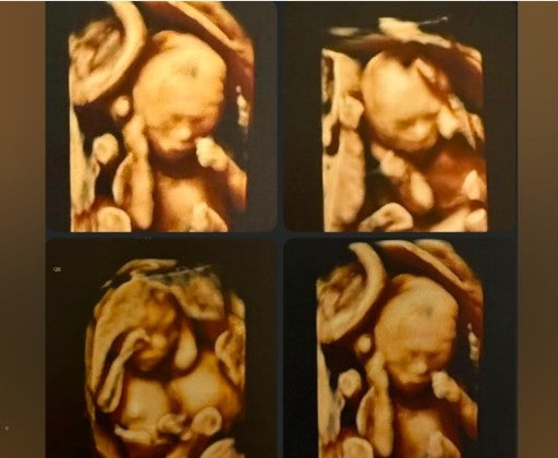 Dr Alexa Bendall, who oversaw Na’amoana’s care, said she had never encountered such a pregnancy before