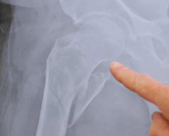 The bison left the victimCarl with a 'painful' injury, with an X-ray showing the patient's femur was broken into multiple pieces