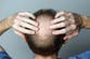 Weight loss drugs linked to loss of hair in major new study