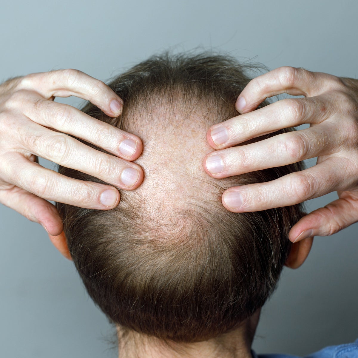 glp-1 hair loss evidence Study Finds a Worrying New Side Effect of Drugs That No One's Talking About : ScienceAlert Ozempic face' and hair loss: