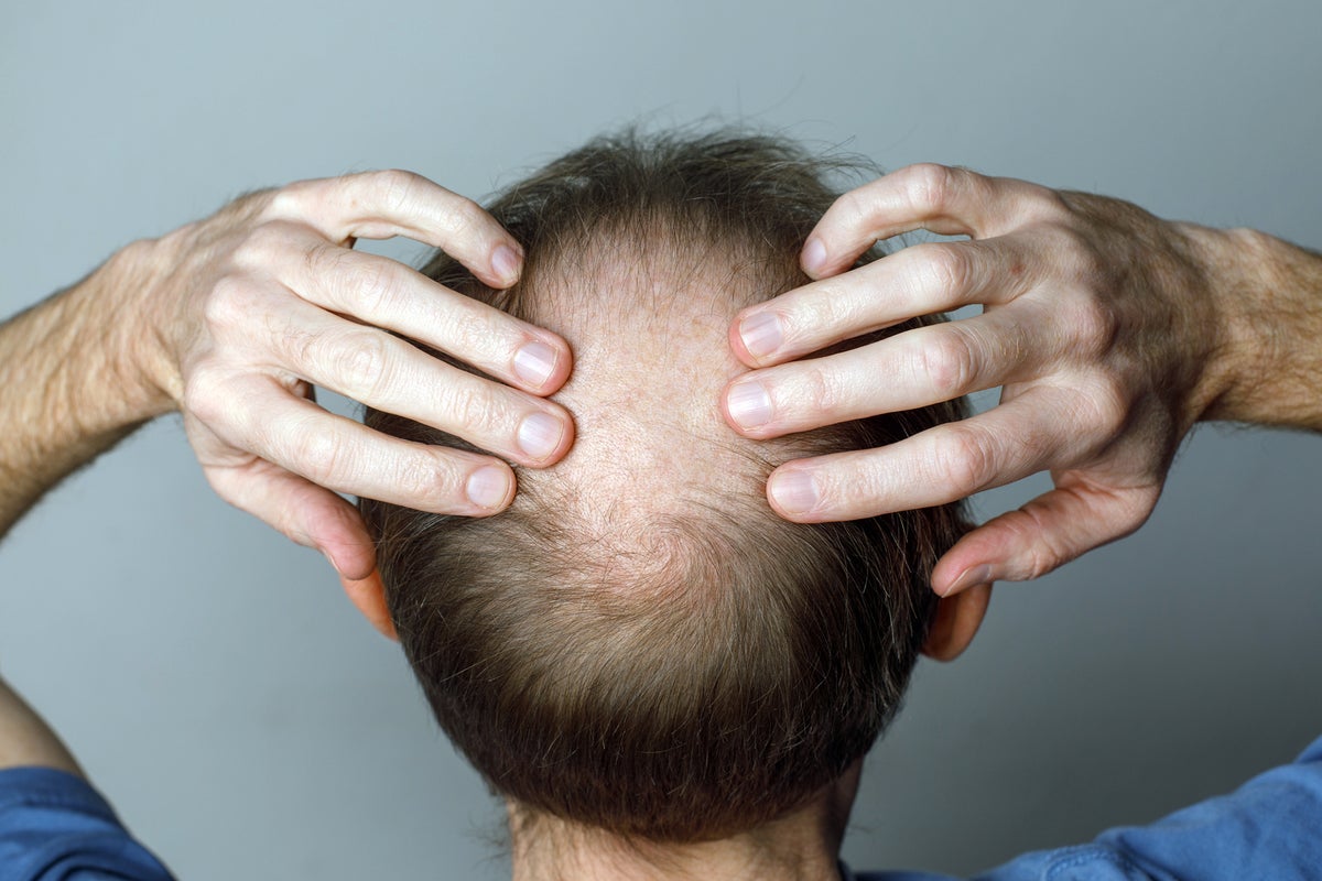 Weight loss drugs linked to loss of hair in major new study – UK Times Weight loss drugs linked to loss of hair in major new study – UK Times
