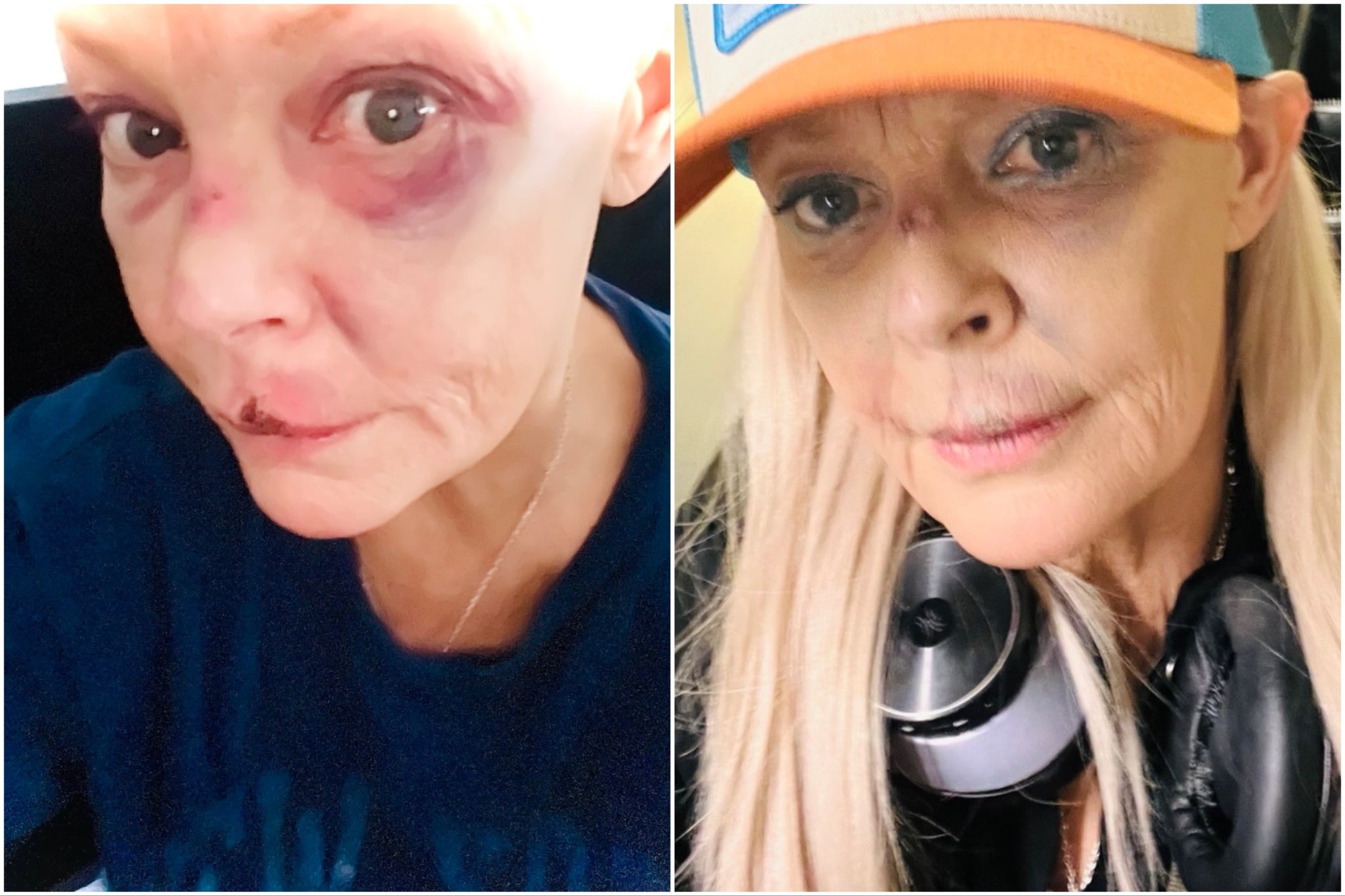 Gail Porter reveals her injuries after London tube station fall