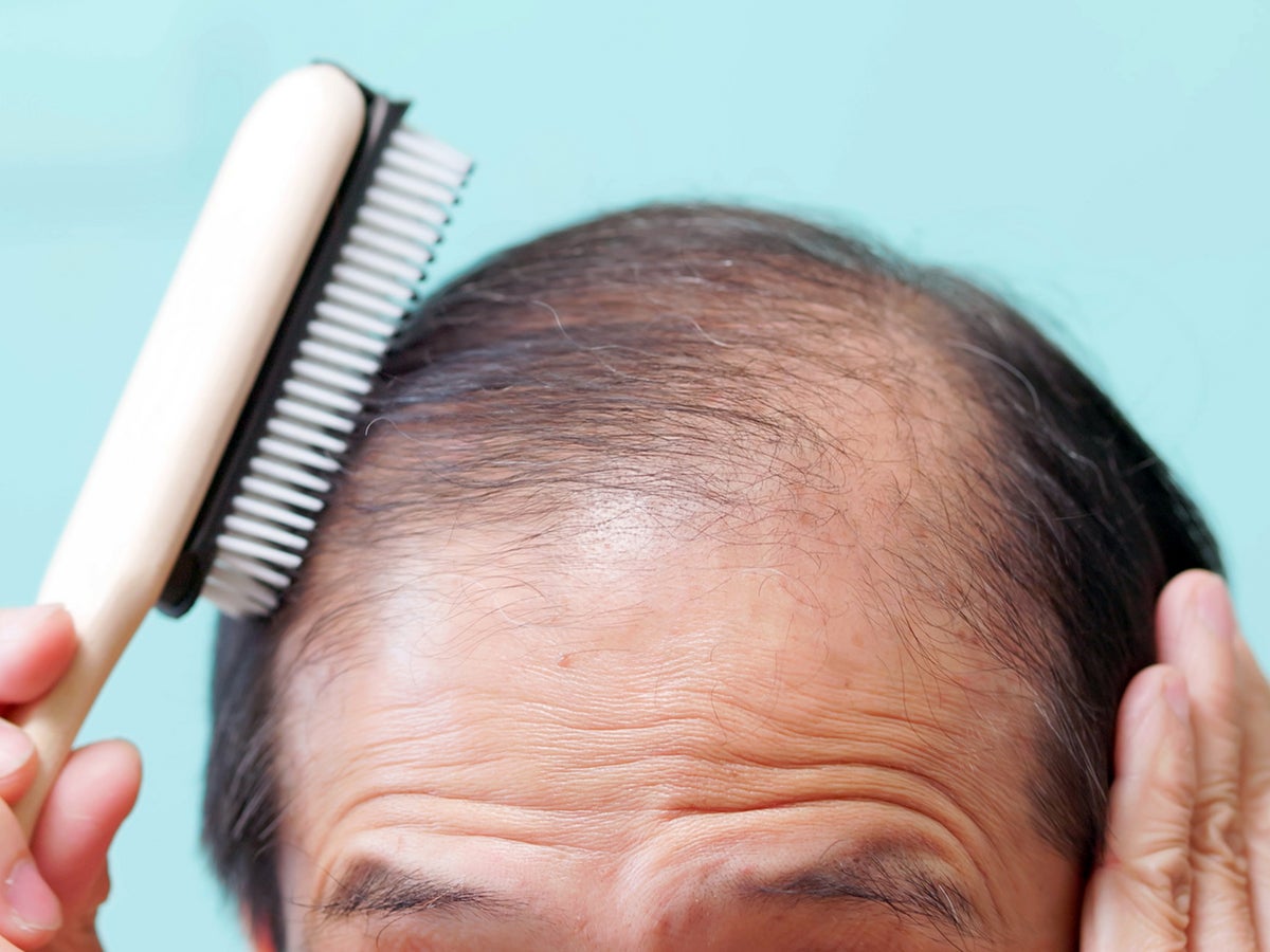 semaglutide hair thinning loss? : r/Semaglutide Now Ozempic patients say they're