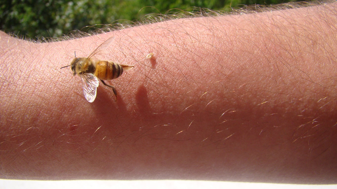 Woman turns to bee venom therapy to treat Lyme disease symptoms