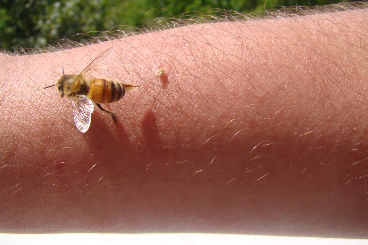 Woman turns to bee venom therapy to treat Lyme disease symptoms Woman turns to bee venom therapy to treat Lyme disease symptoms