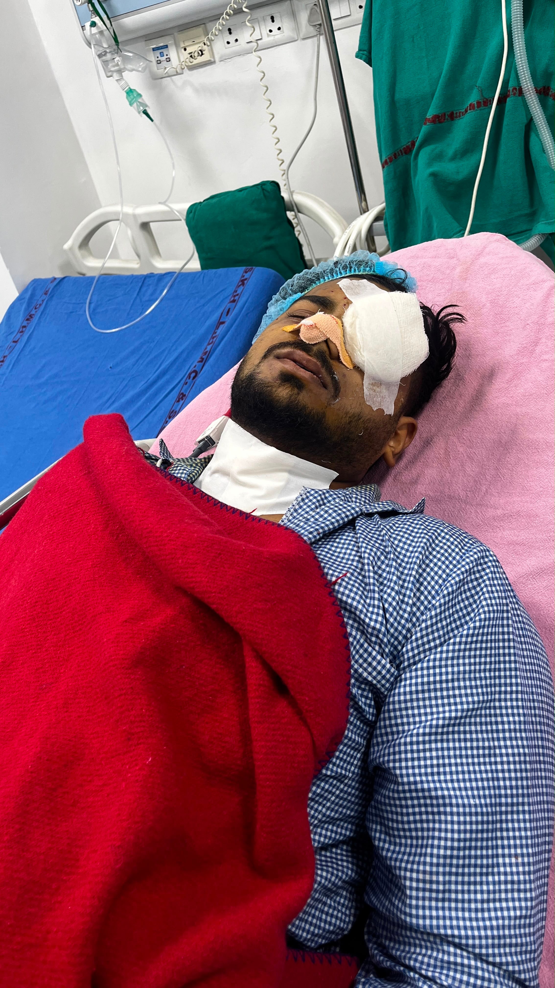 Irshad Mansoori after pellets were removed from his face and near the eye