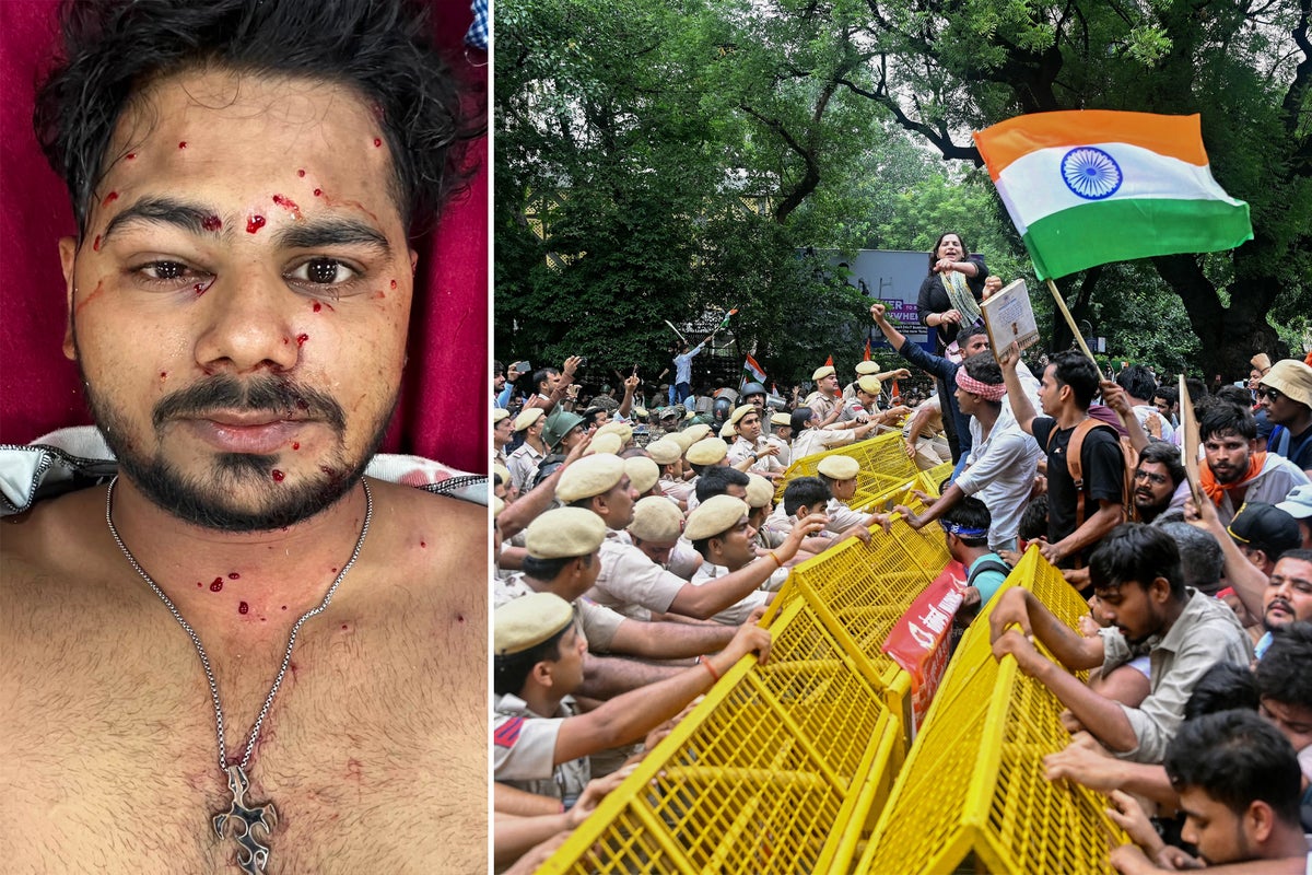 One may lose an eye, another will live with it forever: Delhi protesters describe life-altering injuries after pellet-gun firing – UK Times One may lose an eye, another will live with it forever: Delhi protesters describe life-altering injuries after pellet-gun firing – UK Times