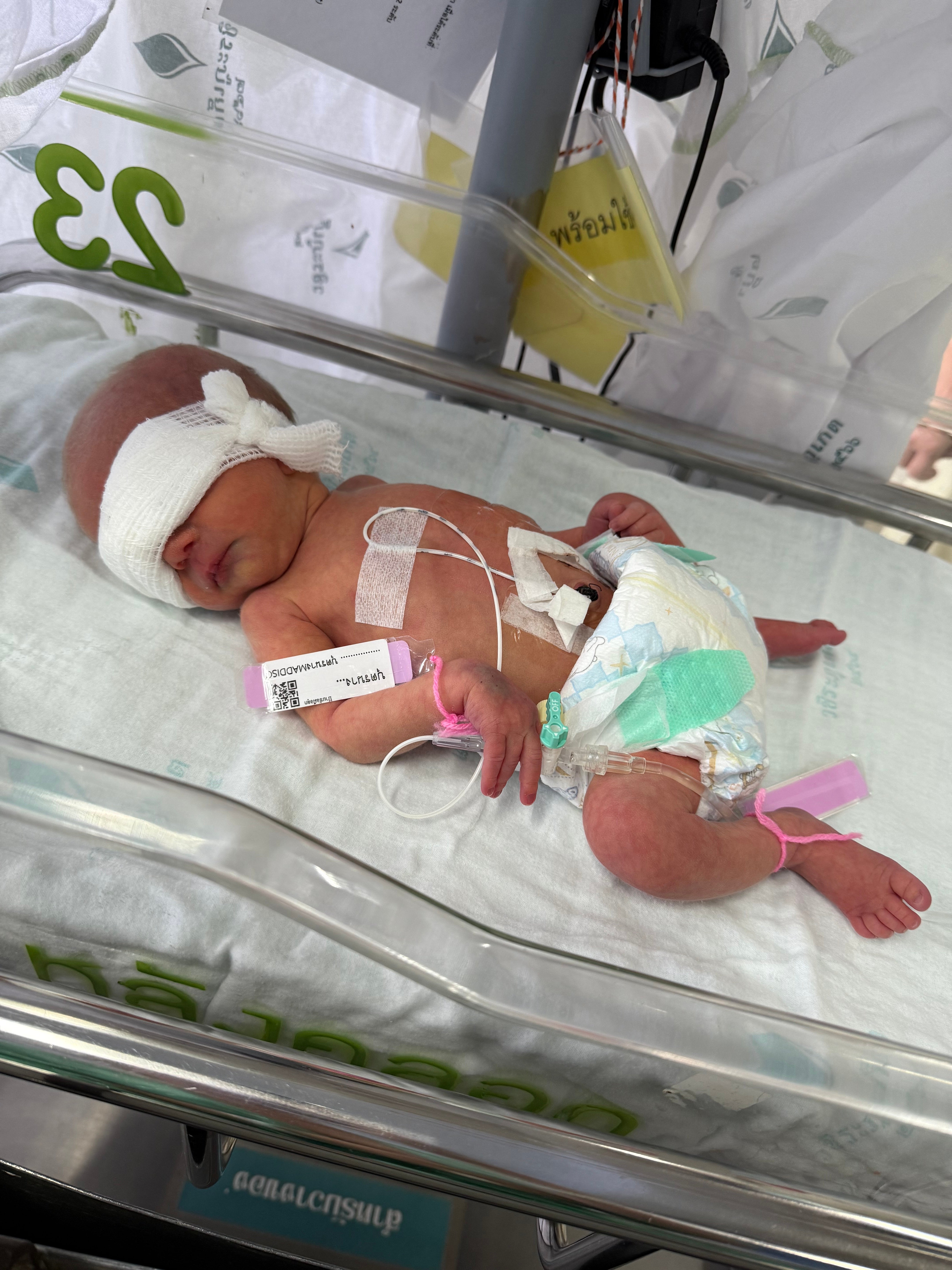 Coco had sepsis when she was born