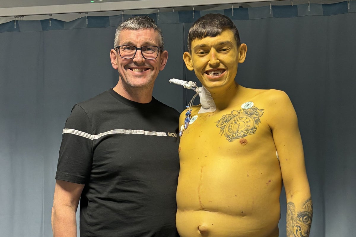 Cheshire man turns bright yellow ‘like Bart Simpson’ due to rare, life-threatening disease Cheshire man turns bright yellow ‘like Bart Simpson’ due to rare, life-threatening disease