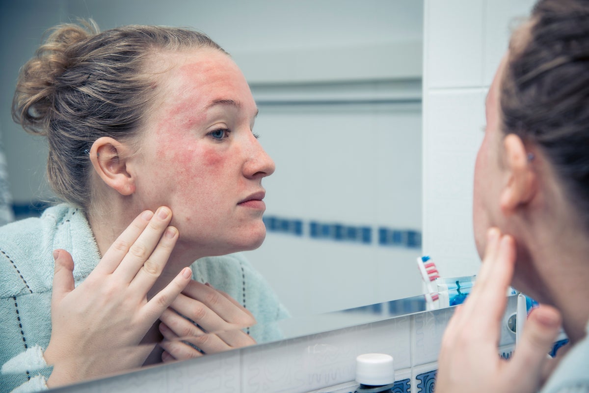 Eczema Antihistamines: Study Questions Treatment Effectiveness