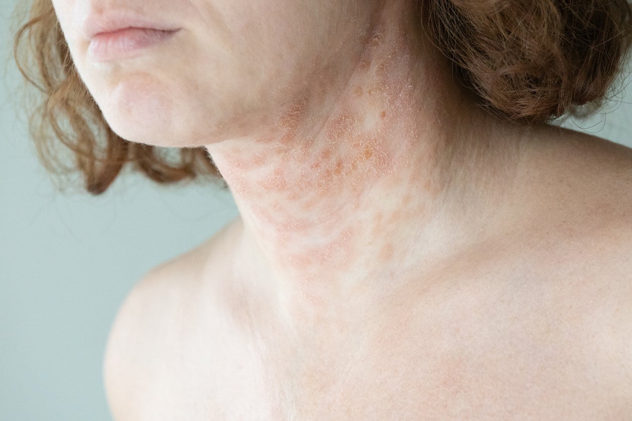 Antihistamines are not recommended by the National Institute for Health and Care Excellence (Nice) to routinely manage the condition (Getty/iStock)