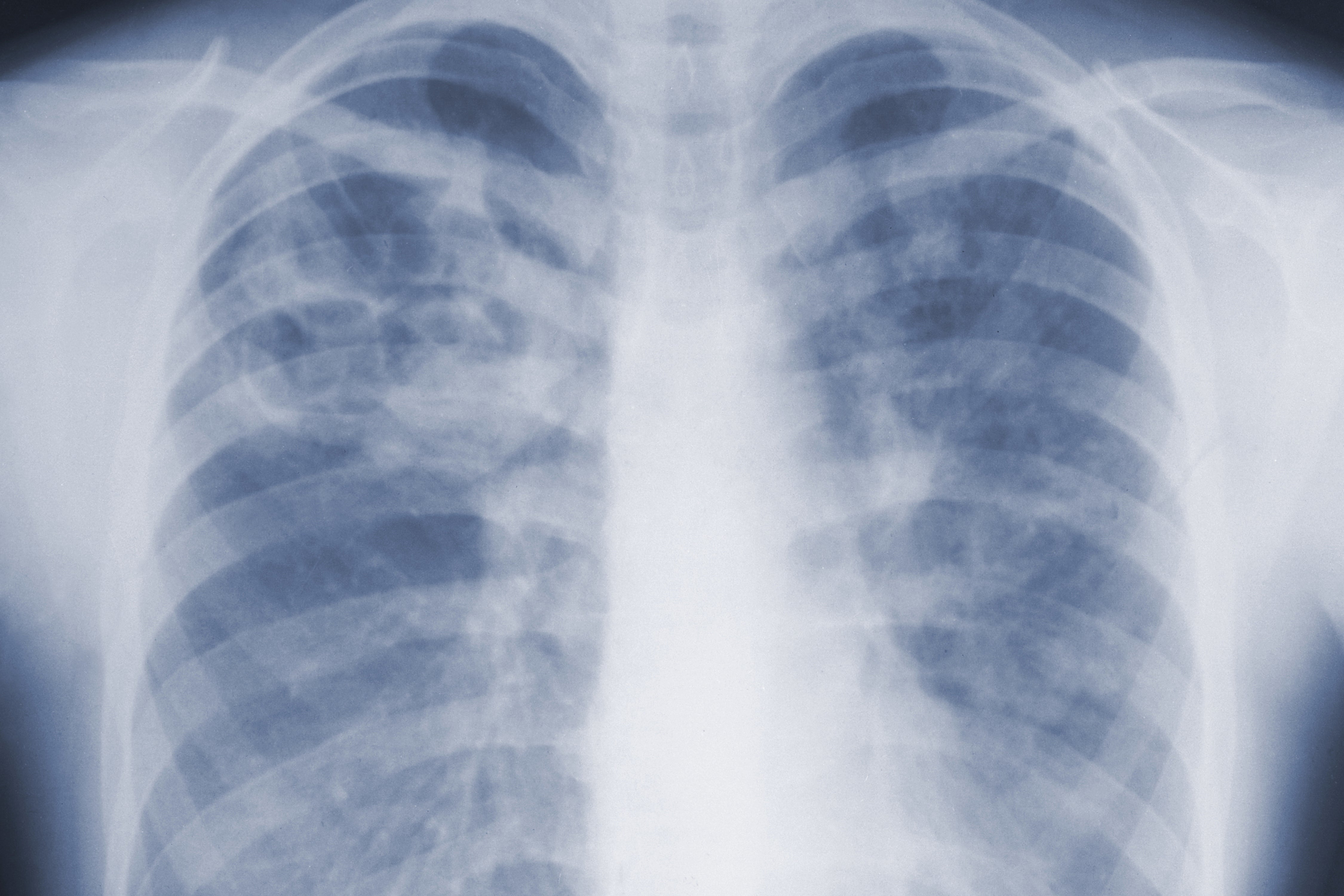 Deadly mold infections may be far more common than doctors realized, CDC study finds