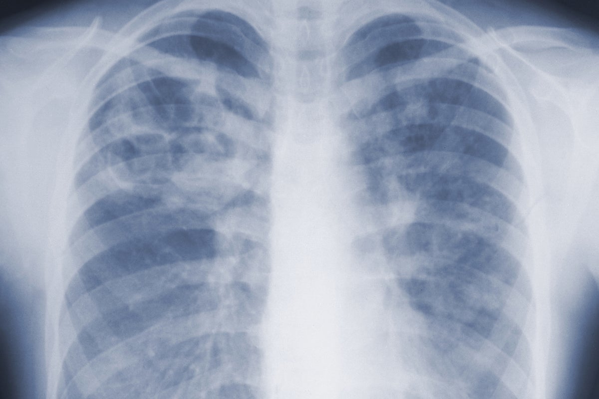 Deadly mold infections may be far more common than doctors realized, CDC study finds Deadly mold infections may be far more common than doctors realized, CDC study finds