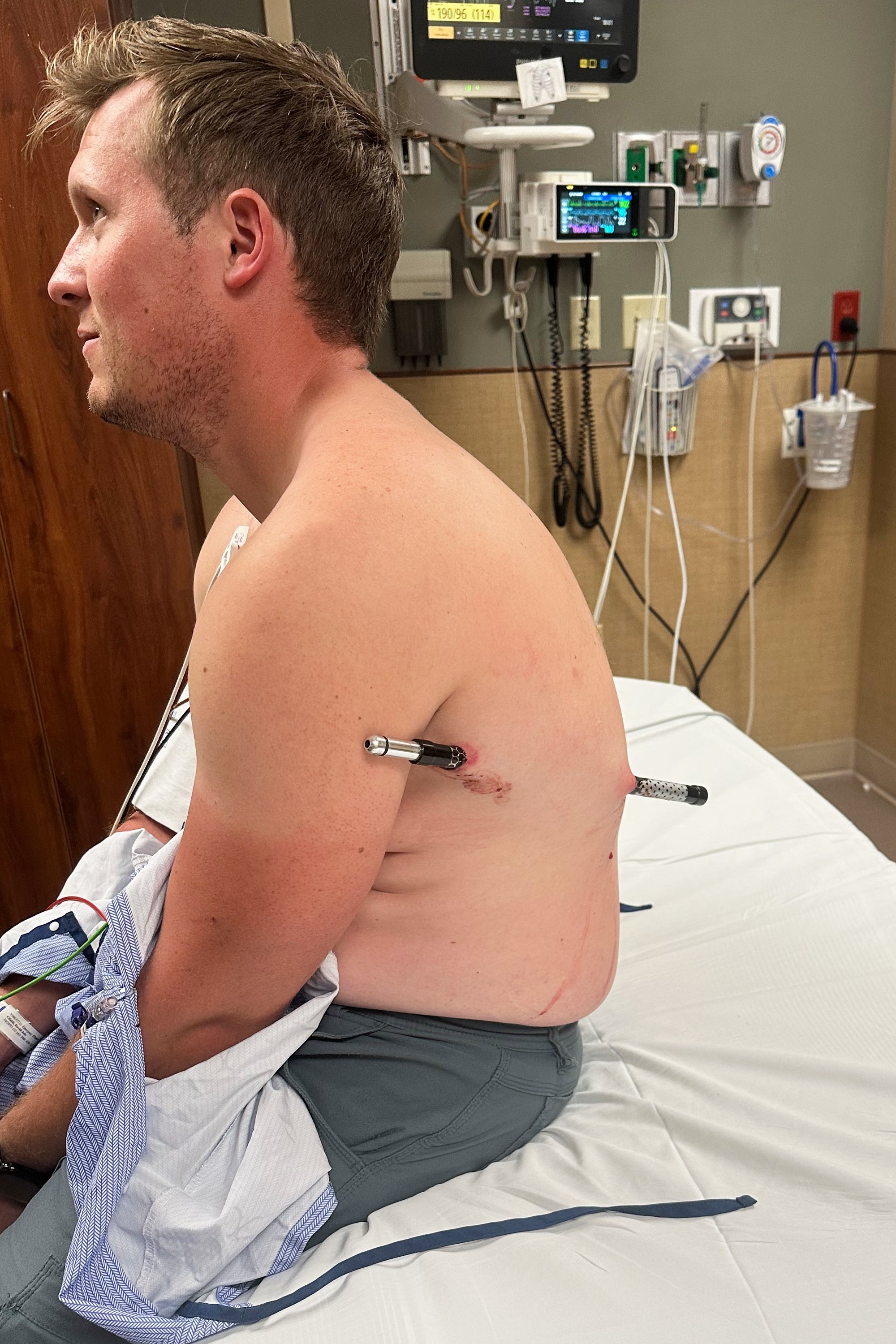 The 44-inch (112-cenimter) steel-tipped pole passed through the flesh beneath Cifaldi’s left arm, missing any vital organs, and protruded from his back