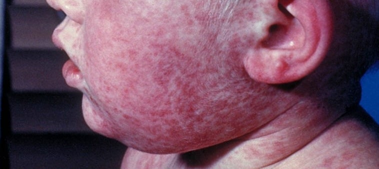 Measles is a nasty virus that can lead to life-threatening brain swelling in children who are unvaccinated.  Distrust in vaccines has been at the heart of America’s measles resurgence, with vaccine skepticism rising 15 percent since 2019 (CDC)