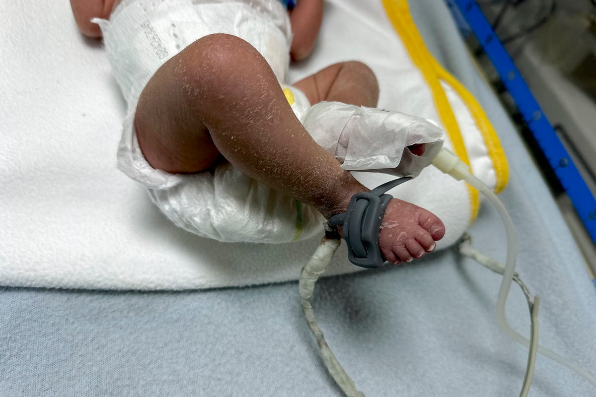 Miscarriages soar in Gaza and birth rate drops, UN report finds