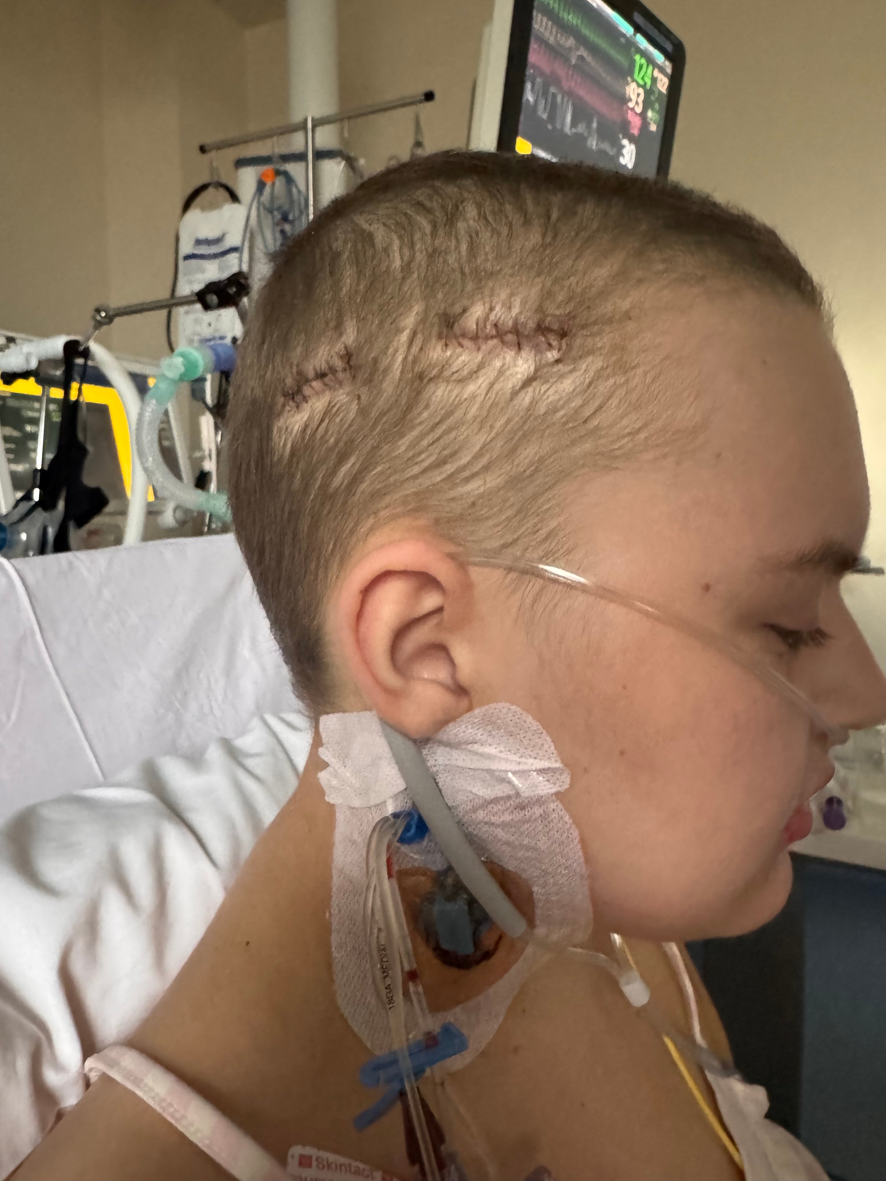 She had burr hole surgery (Collect/PA Real Life)