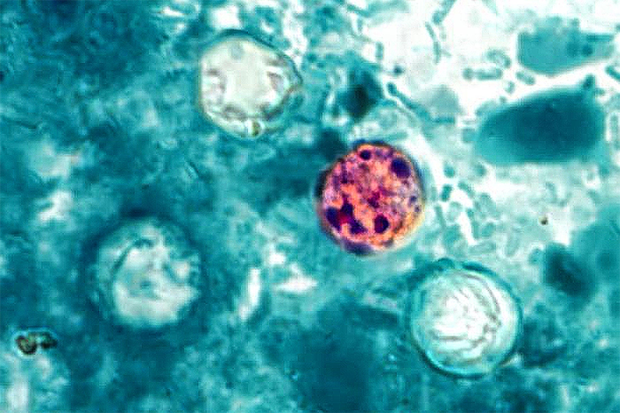 Federal health officials have linked the parasite outbreak to more than 22,000 illnesses and 500 hospitalizations nationwide, with Michigan hit hardest