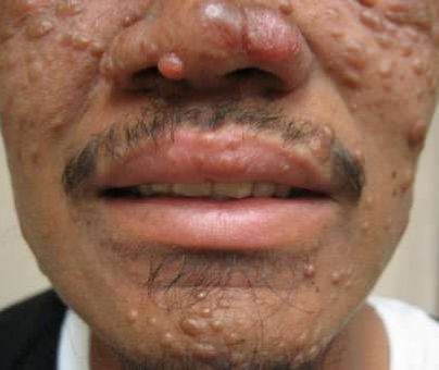 Leprosy can cause lesions and large bumps all over the skin. Cases can impact a person’s nerves and muscles