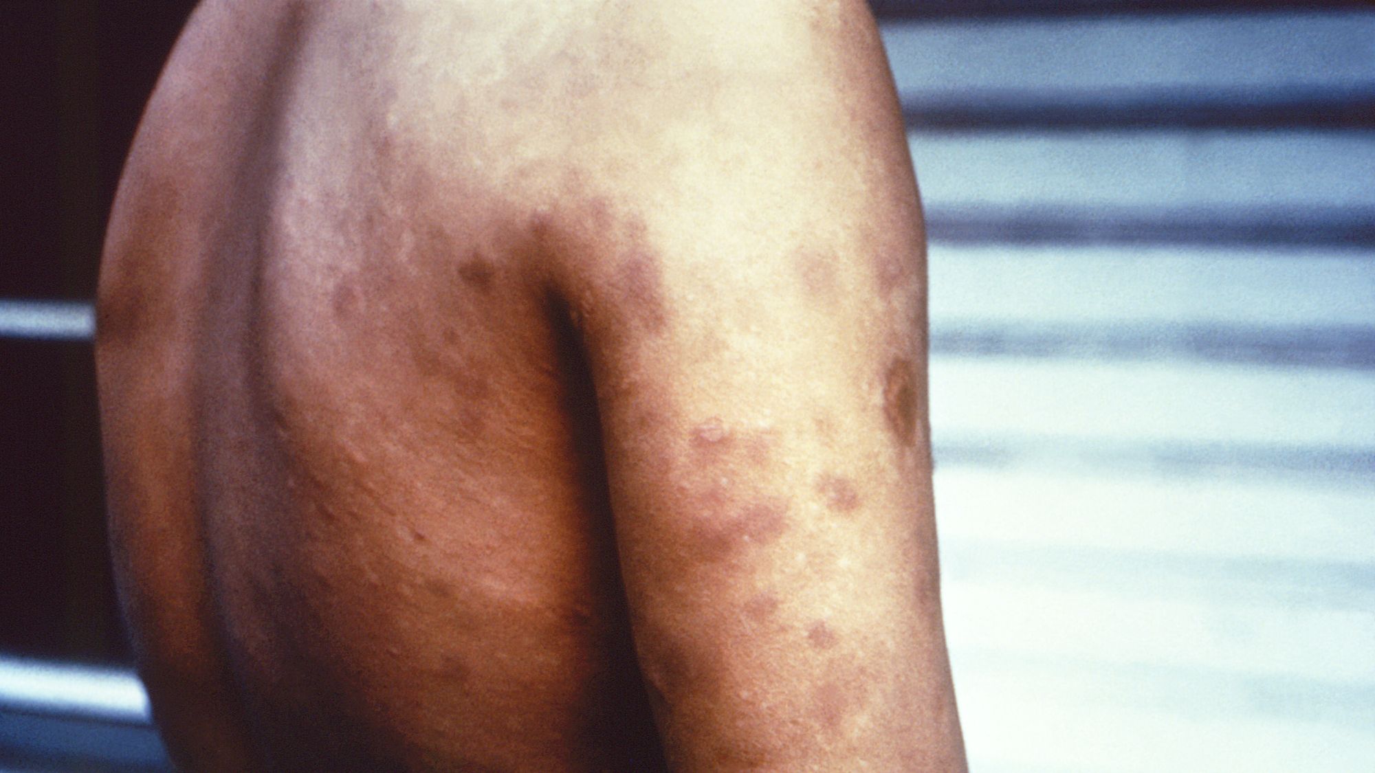 Cases of leprosy have been rising in Florida but experts don’t know why