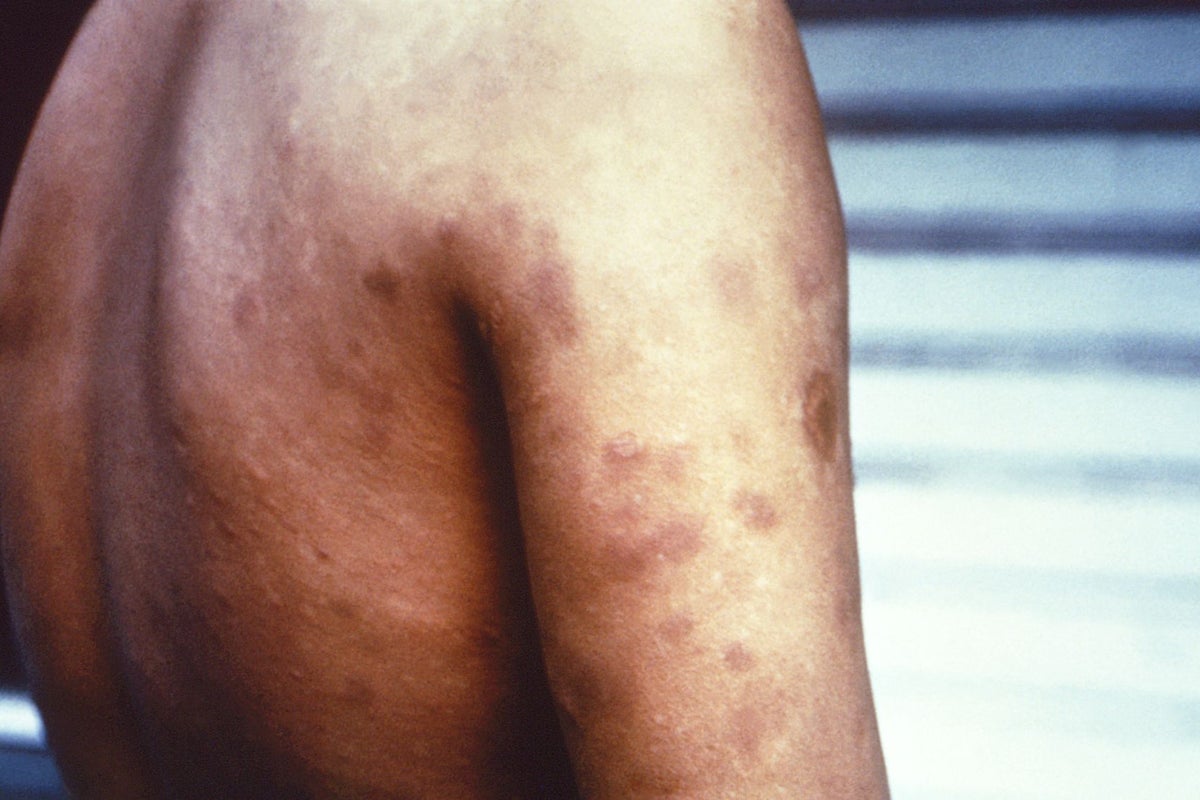 Health officials monitor rising reports of Hansen's disease in Florida