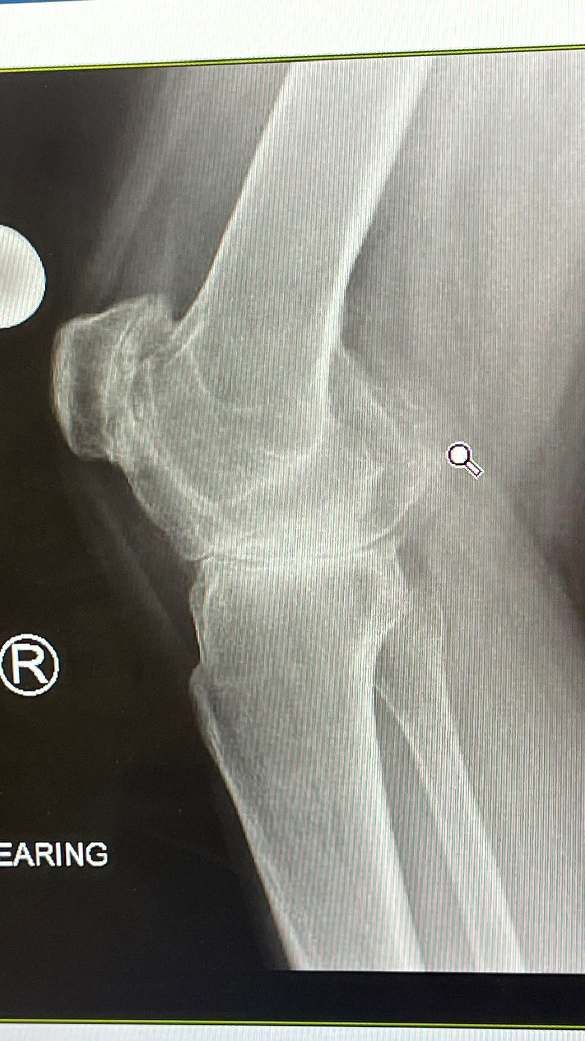 An X-ray of Phoebe’s knee (Collect/PA Real Life)