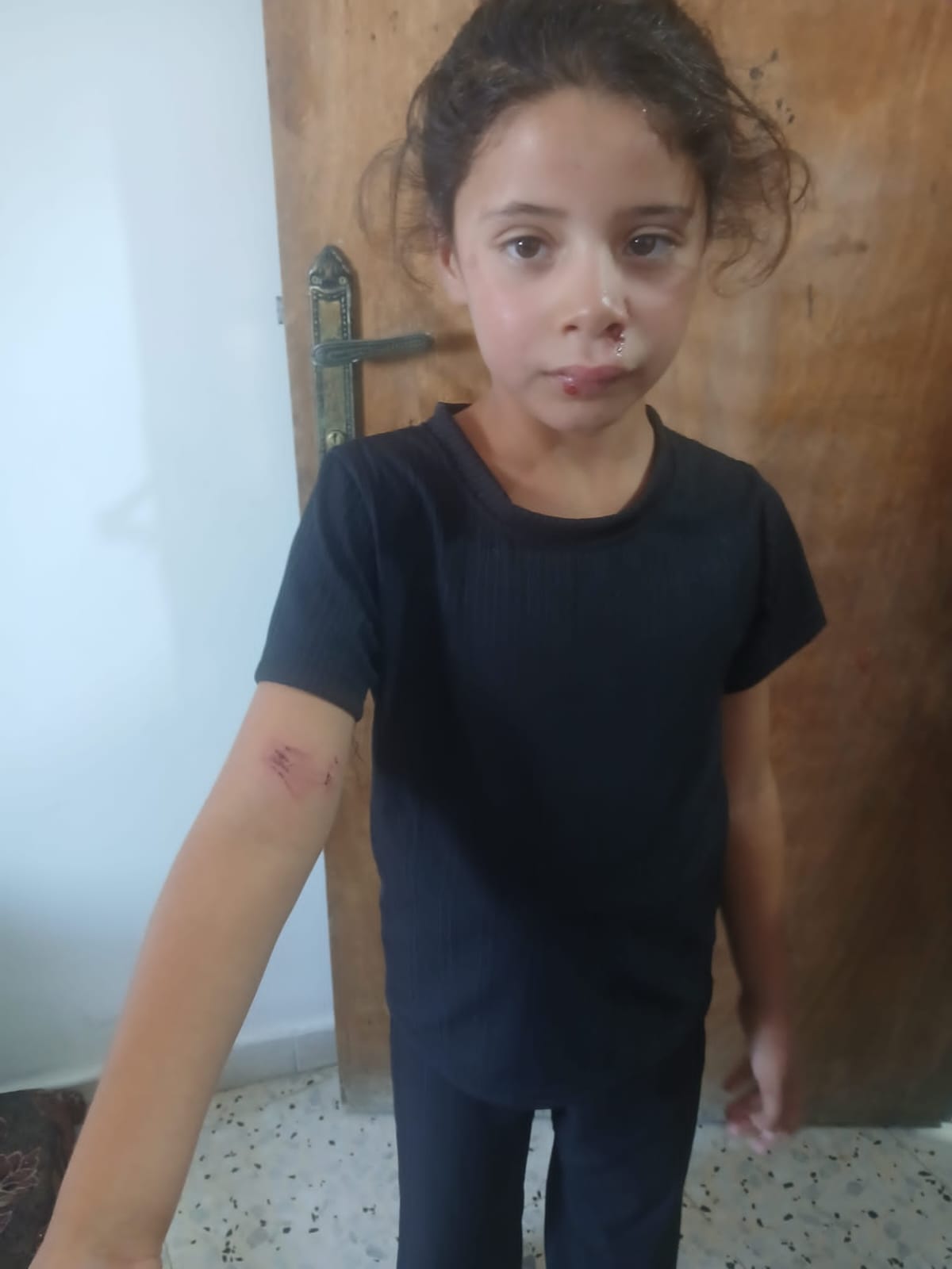 Razan, 8, was left with injuries to her face after being struck by a stone during the attack