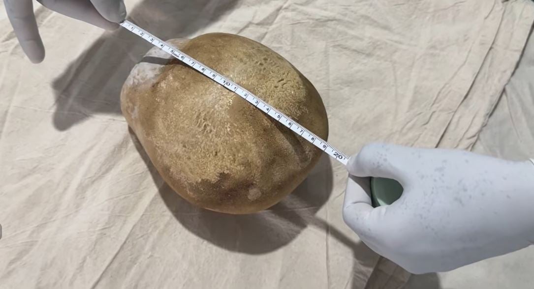 A massive bladder stone was removed from a patient, 55, in Sri Lanka (Newsfirst English/ YouTube)